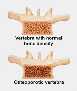 osteoporosis-vert-with-normal-vert-253x300
